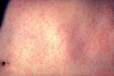 Measles outbreaks in Canada