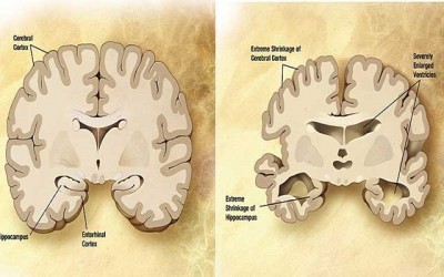 Alzheimerâ€™s risk linked to energy shortage in brainâ€™s immune cells