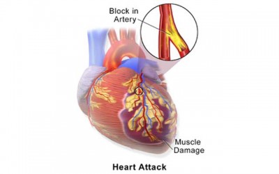 Low iron levels may increase risk of heart disease, says study