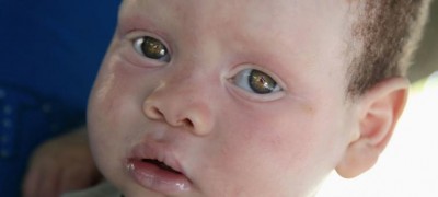 â€˜End the ongoing atrocitiesâ€™ against people with albinism in Malawi, say UN rights experts