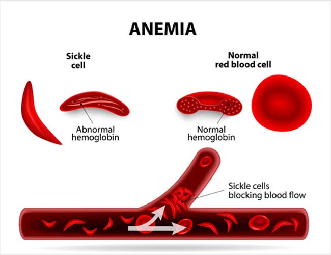 5Things You Should Know About Sickle Cell Anaemia