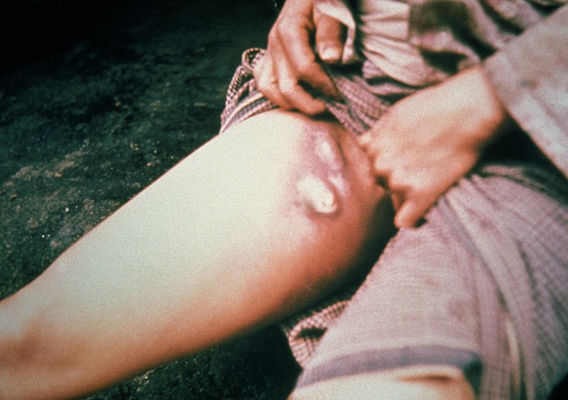 Oregon reports rare case of bubonic plague