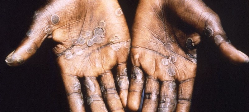 India detects first suspected mpox case