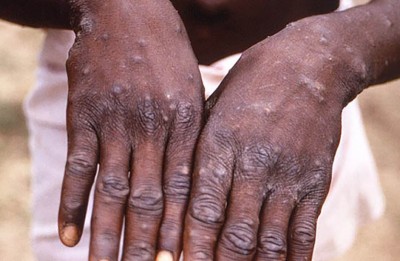 Italian man gets Covid-19, monkeypox, HIV all at once after unprotected sex with men