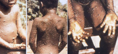 As monkeypox cases rise globally, Centre directs NCdC, ICMR to keep close watch