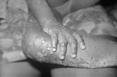 Venezuela reports its first monkeypox case