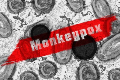 Nigerian man tests positive for Monkeypox in Delhi, 2nd case in capital