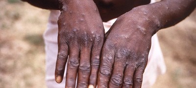 Kerala reports another monkeypox case, state tally now 5