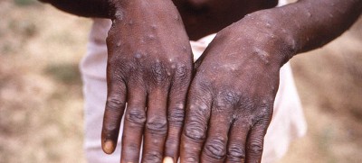 Vaccine expected to induce strong monkeypox virus immune response, shows research