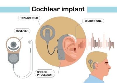 CMRI Kolkata introduces SmartNav Cochlear Implant Technology for first time in East India