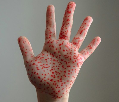 Over 100 dead in Bangladesh measles outbreak. Is India at risk?