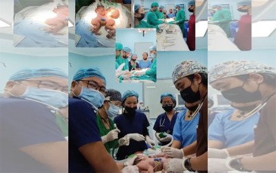 Conjoined twins successfully separated for the first time in Mizoram