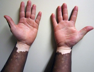 Vitiligo: Controversial skin cream may soon come to UK