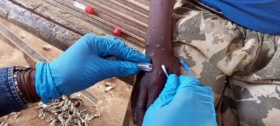 Mpox outbreak: WHO approves first diagnostic test for emergency use