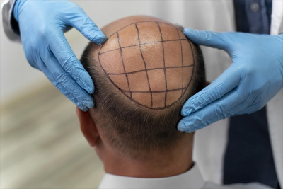 Common Myths About Hair Transplants in Turkey: Separating Fact from Fiction