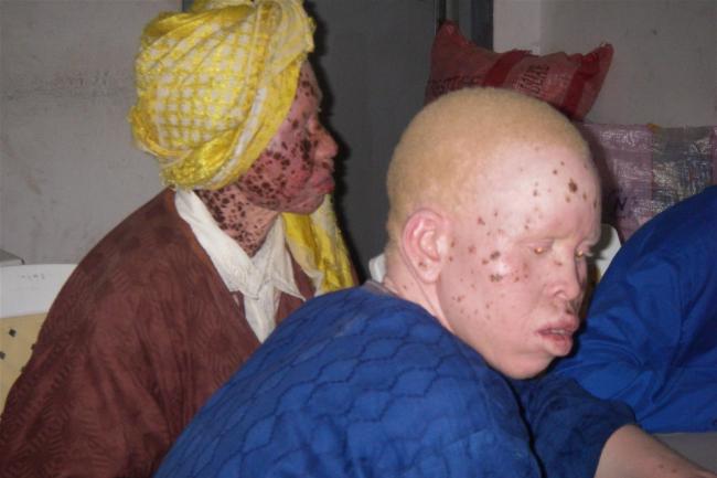 Killing of Albino baby in Tanzania condemned by UN rights chief