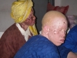 Killing of Albino baby in Tanzania condemned by UN rights chief